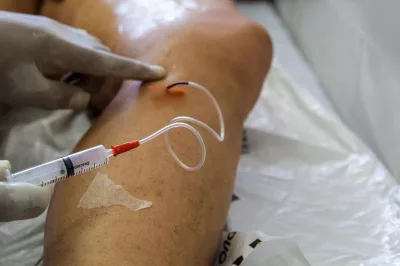 Pandemia fez cirurgias de varizes pelo SUS despencarem 69% no país