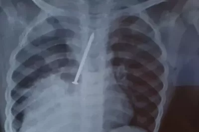 Canavieiras: Menino morre após passar 1 ano com prego no pulmão