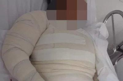 Mulher tem 50% do corpo queimado com água fervente na Bahia; ex é suspeito