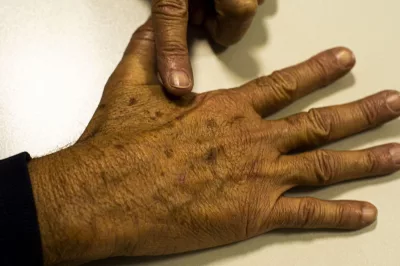 Tecnologia para tratar câncer de pele é aprovada para uso no SUS